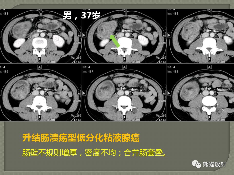 【PPT】原发性胃肠道淋巴瘤的影像诊断及鉴别诊断