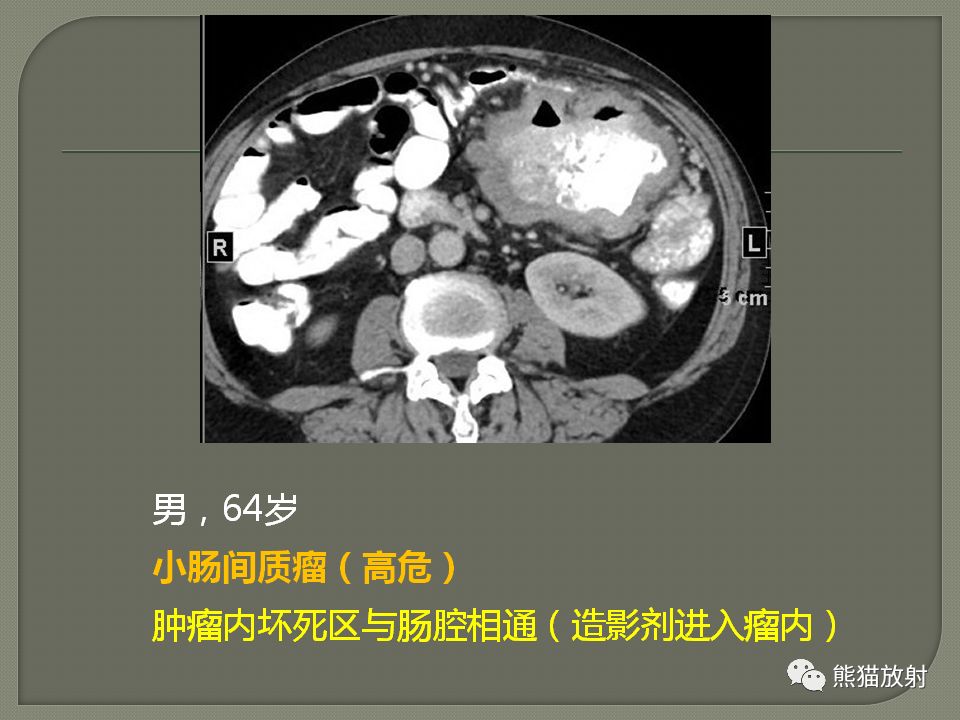 【PPT】原发性胃肠道淋巴瘤的影像诊断及鉴别诊断