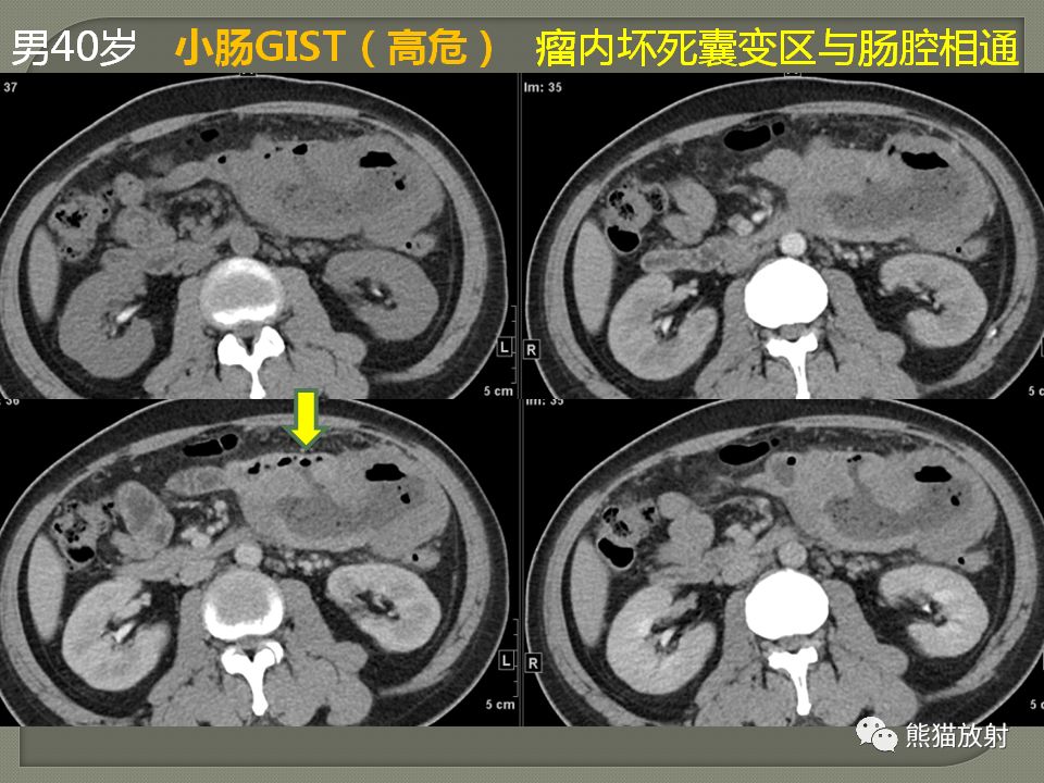 【PPT】原发性胃肠道淋巴瘤的影像诊断及鉴别诊断