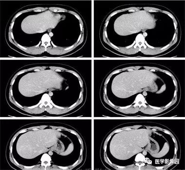 【病例】不典型肝细胞肝癌1例CT影像表现 【病例】不典型肝细胞肝癌1例CT影像表现