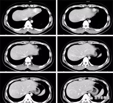 【病例】不典型肝细胞肝癌1例CT影像表现 【病例】不典型肝细胞肝癌1例CT影像表现