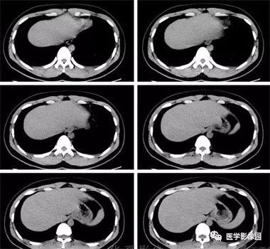 【病例】不典型肝细胞肝癌1例CT影像表现 【病例】不典型肝细胞肝癌1例CT影像表现