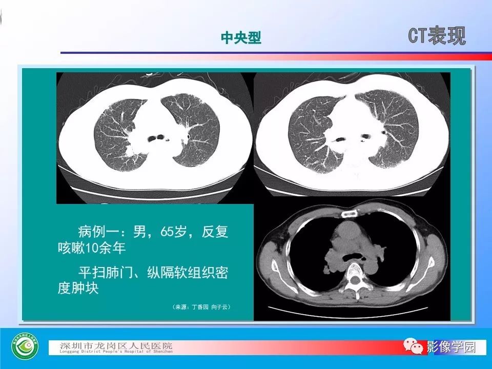【PPT】小细胞肺癌的CT诊断和鉴别诊断
