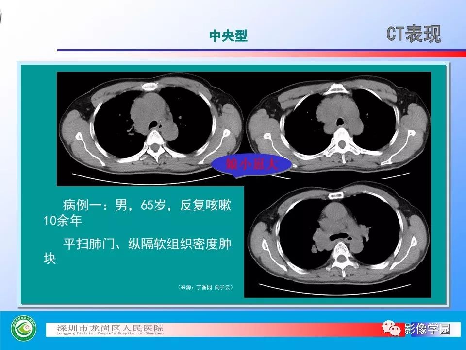 【PPT】小细胞肺癌的CT诊断和鉴别诊断