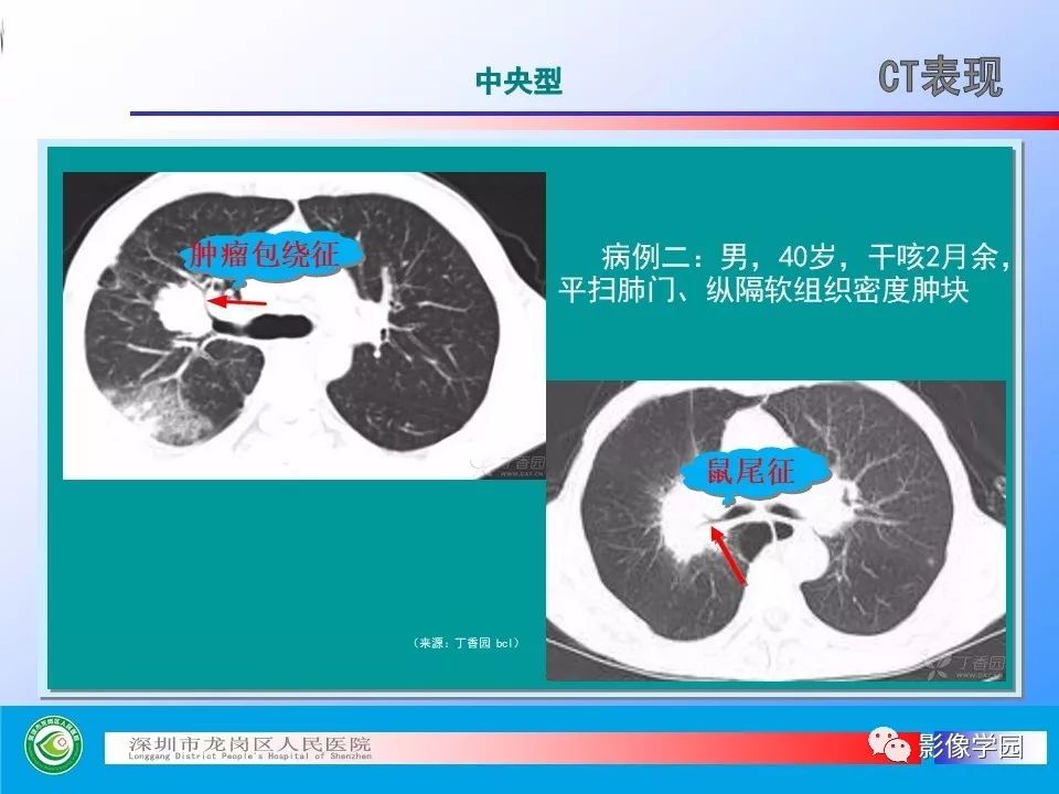 【PPT】小细胞肺癌的CT诊断和鉴别诊断