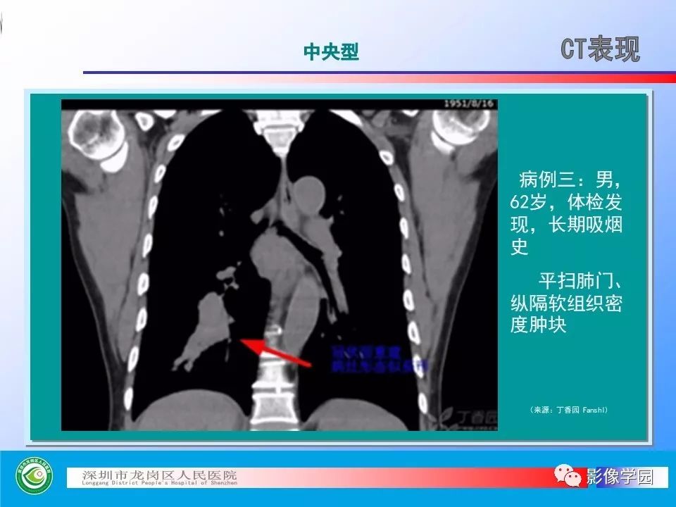 【PPT】小细胞肺癌的CT诊断和鉴别诊断
