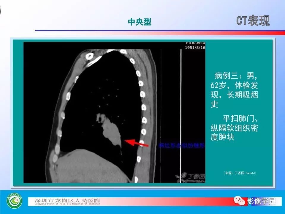 【PPT】小细胞肺癌的CT诊断和鉴别诊断