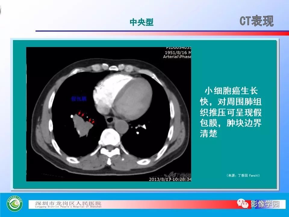 【PPT】小细胞肺癌的CT诊断和鉴别诊断