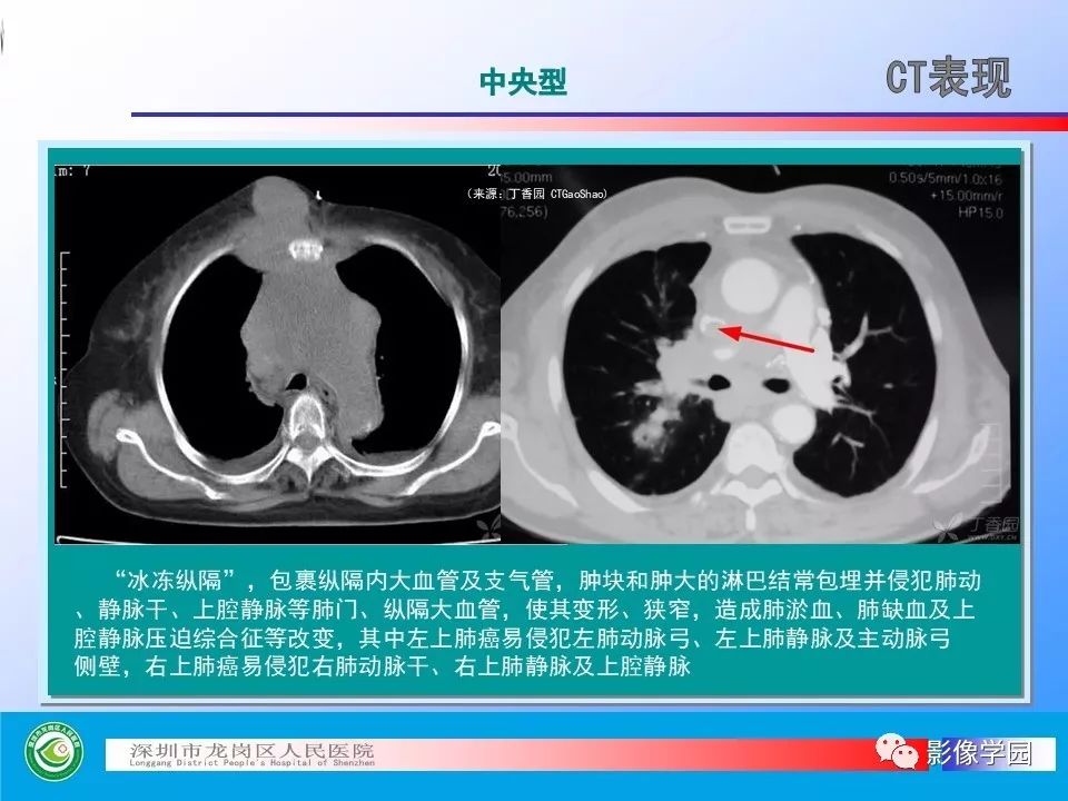 【PPT】小细胞肺癌的CT诊断和鉴别诊断
