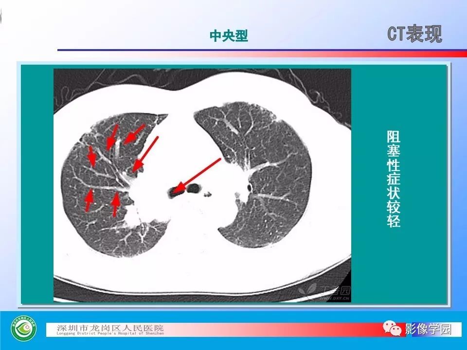 【PPT】小细胞肺癌的CT诊断和鉴别诊断