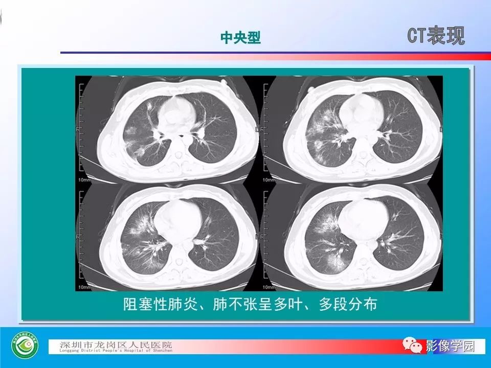 【PPT】小细胞肺癌的CT诊断和鉴别诊断