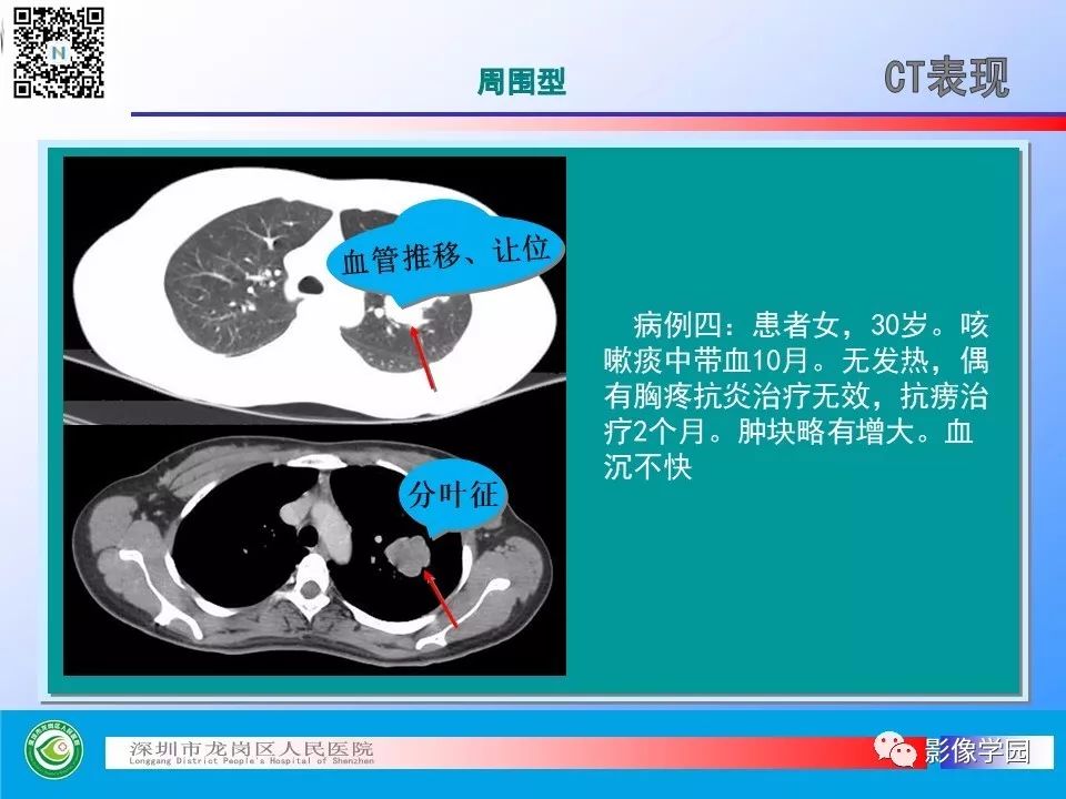 【PPT】小细胞肺癌的CT诊断和鉴别诊断