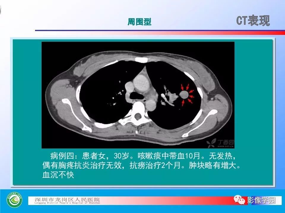 【PPT】小细胞肺癌的CT诊断和鉴别诊断