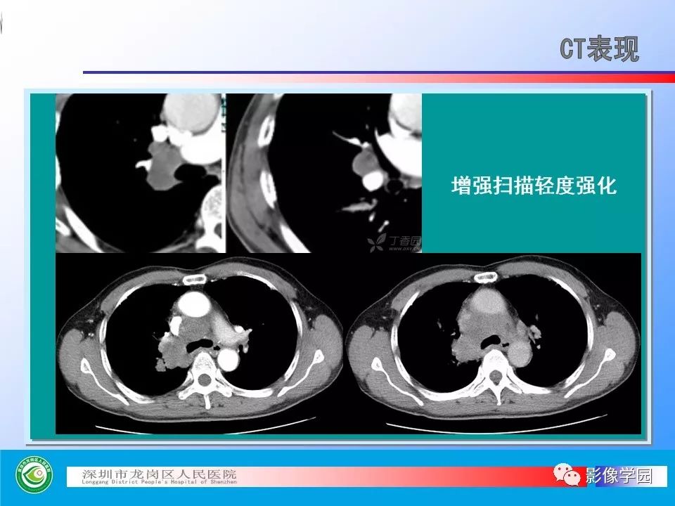 【PPT】小细胞肺癌的CT诊断和鉴别诊断