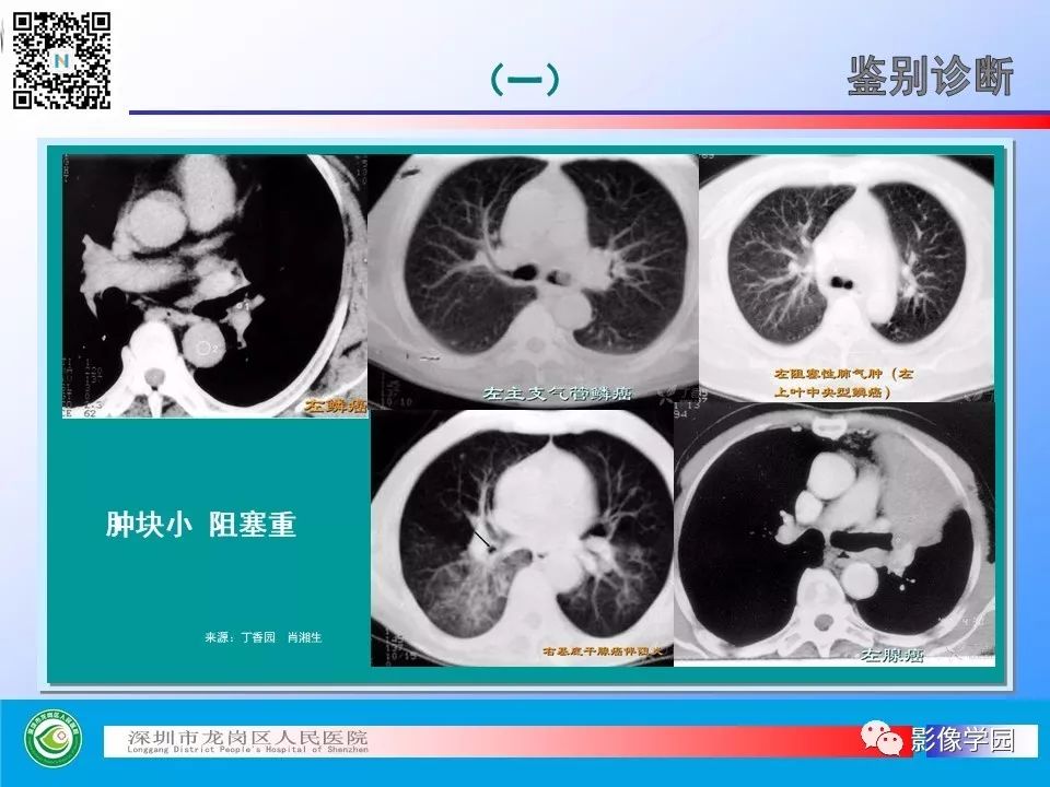 【PPT】小细胞肺癌的CT诊断和鉴别诊断