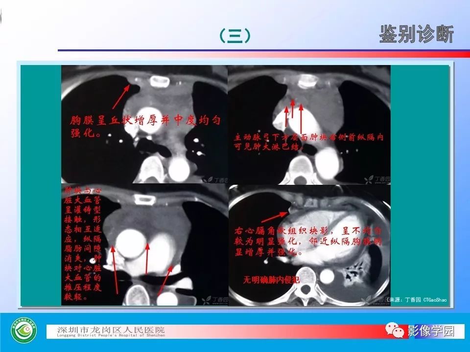 【PPT】小细胞肺癌的CT诊断和鉴别诊断