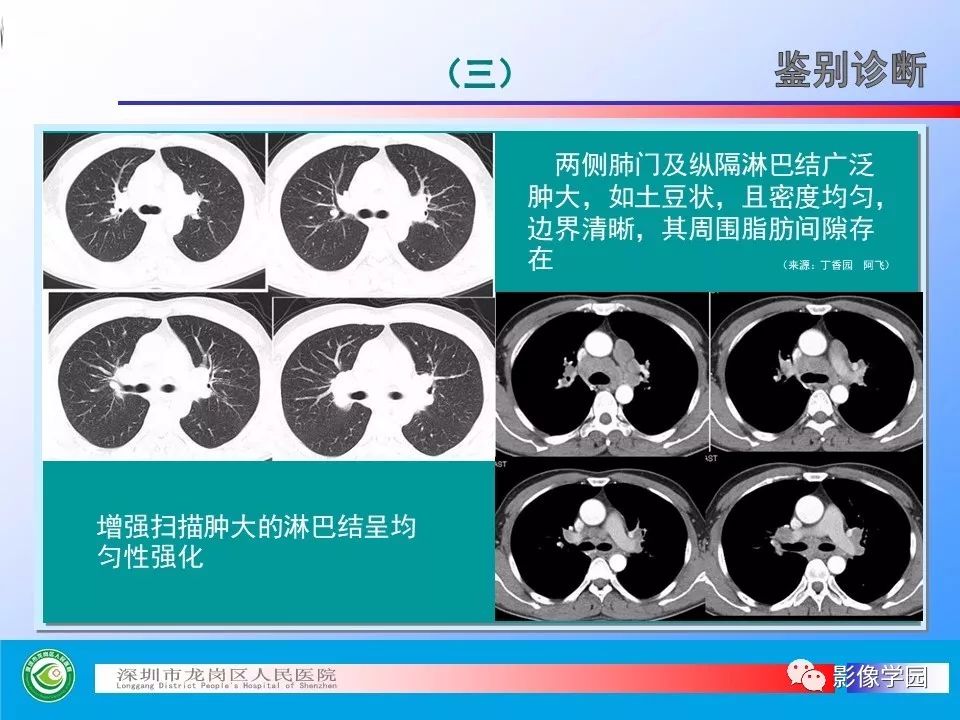 【PPT】小细胞肺癌的CT诊断和鉴别诊断