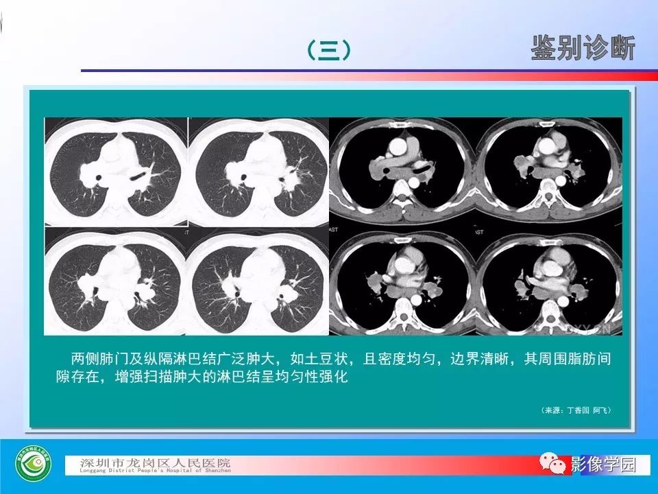【PPT】小细胞肺癌的CT诊断和鉴别诊断