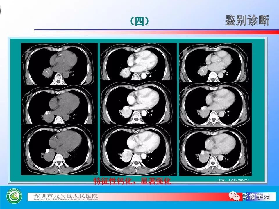 【PPT】小细胞肺癌的CT诊断和鉴别诊断