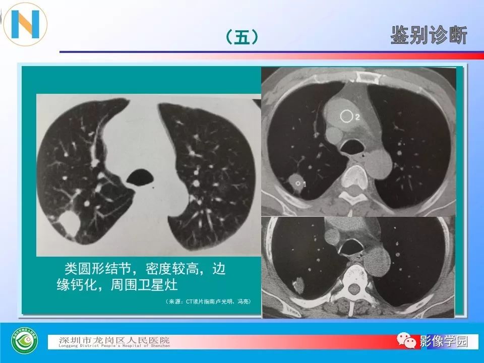 【PPT】小细胞肺癌的CT诊断和鉴别诊断