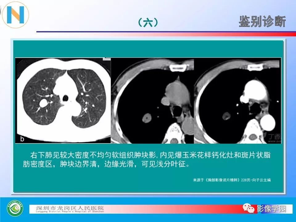 【PPT】小细胞肺癌的CT诊断和鉴别诊断