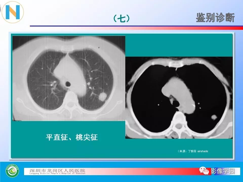 【PPT】小细胞肺癌的CT诊断和鉴别诊断