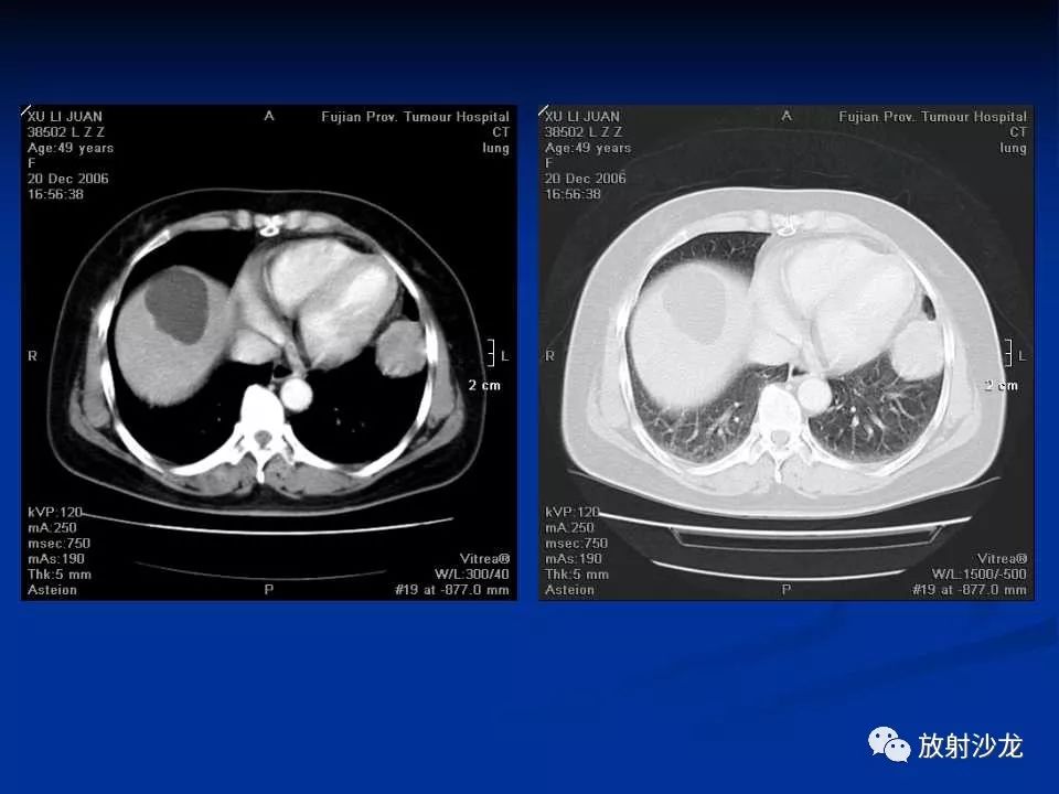 【病例】肺硬化性血管瘤1例CT影像表现