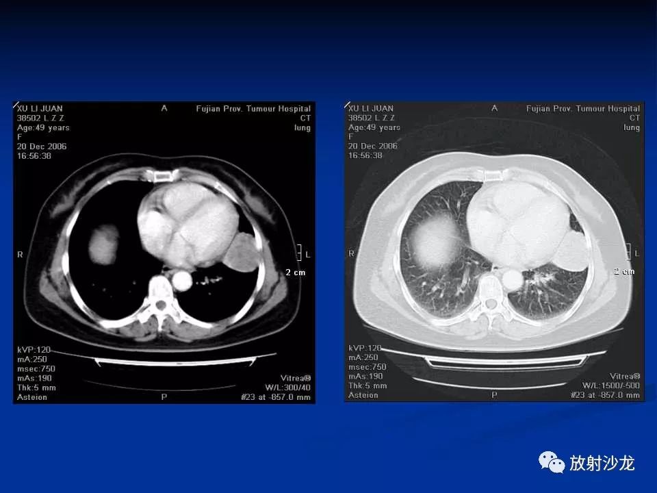 【病例】肺硬化性血管瘤1例CT影像表现