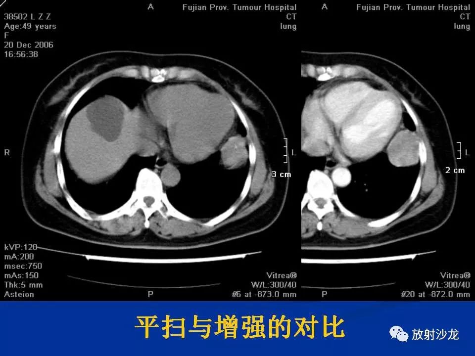 【病例】肺硬化性血管瘤1例CT影像表现
