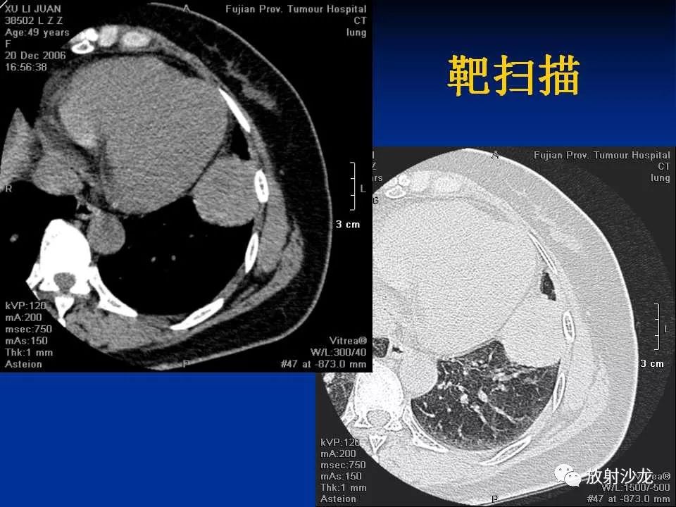 【病例】肺硬化性血管瘤1例CT影像表现