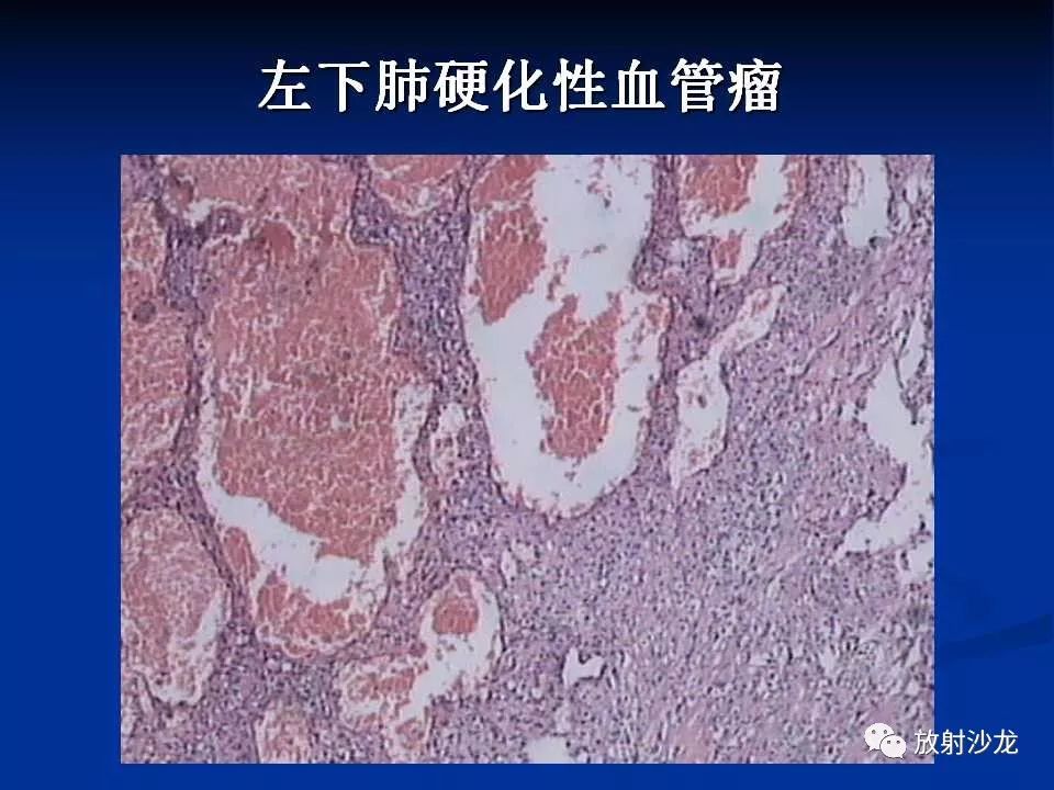 【病例】肺硬化性血管瘤1例CT影像表现