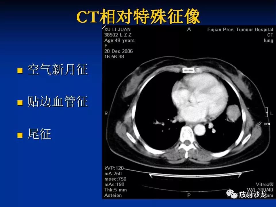 【病例】肺硬化性血管瘤1例CT影像表现