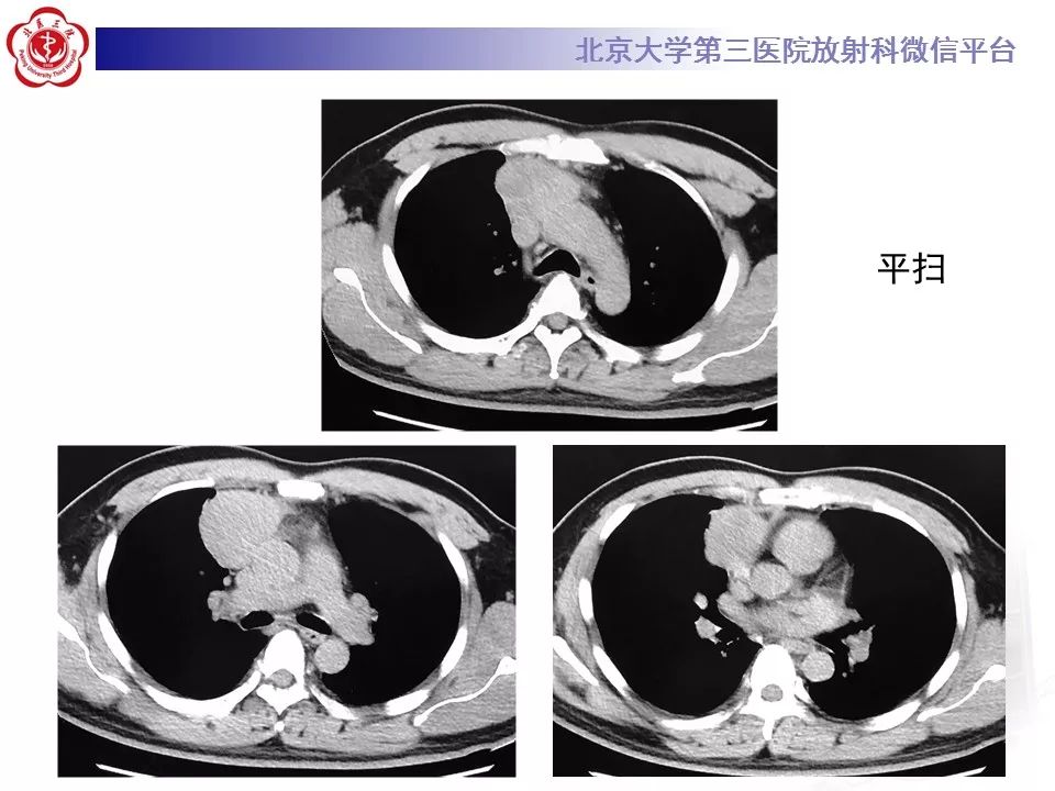【病例】胸腺神经内分泌肿瘤1例CT影像表现