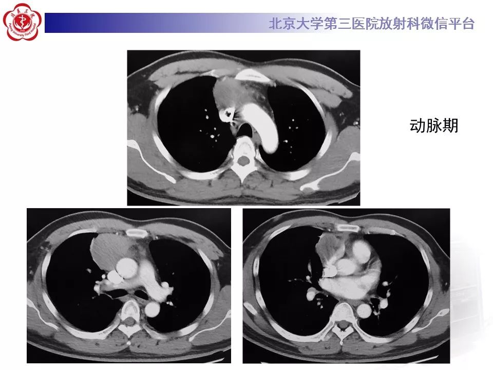 【病例】胸腺神经内分泌肿瘤1例CT影像表现