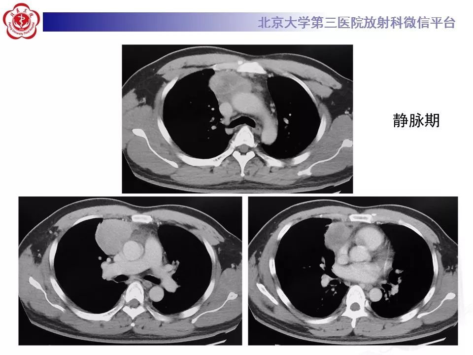 【病例】胸腺神经内分泌肿瘤1例CT影像表现