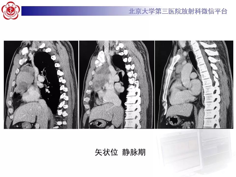 【病例】胸腺神经内分泌肿瘤1例CT影像表现