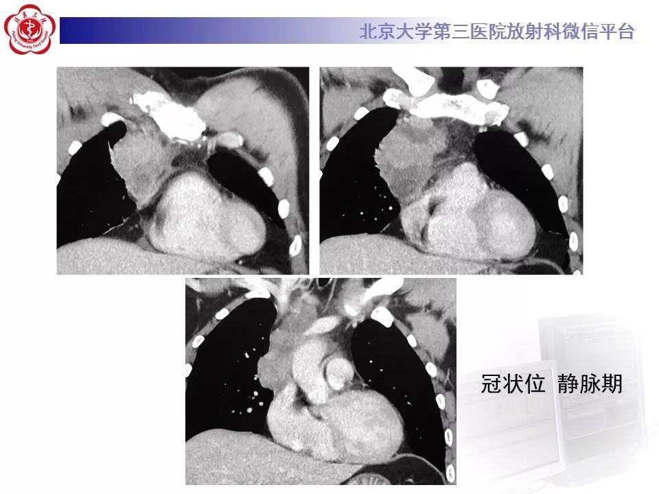 【病例】胸腺神经内分泌肿瘤1例CT影像表现