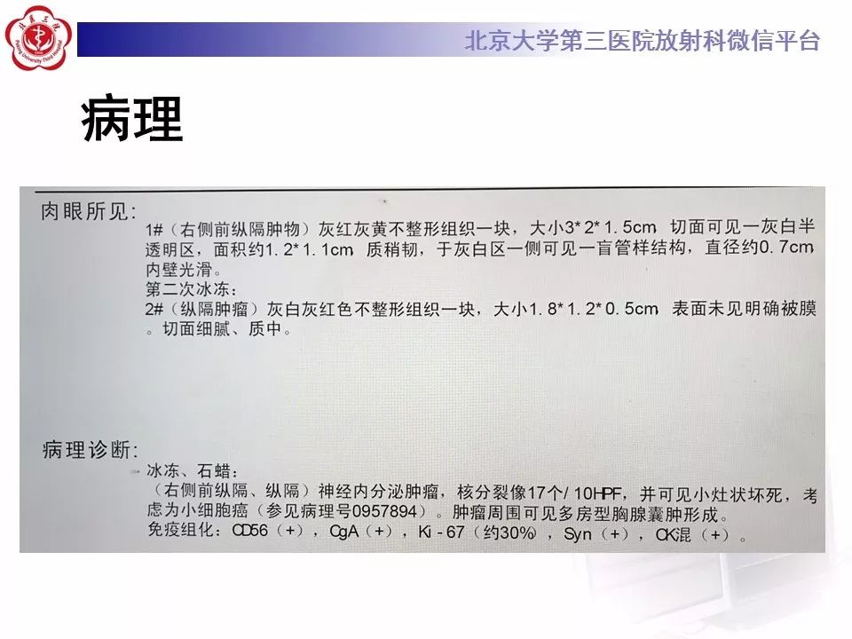 【病例】胸腺神经内分泌肿瘤1例CT影像表现