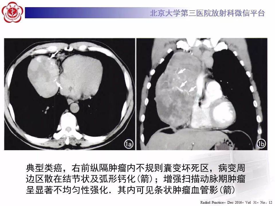 【病例】胸腺神经内分泌肿瘤1例CT影像表现