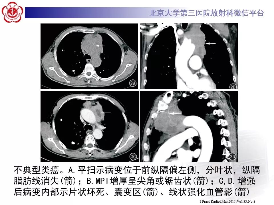 【病例】胸腺神经内分泌肿瘤1例CT影像表现