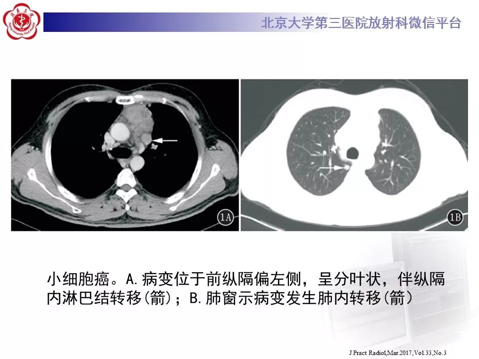 【病例】胸腺神经内分泌肿瘤1例CT影像表现