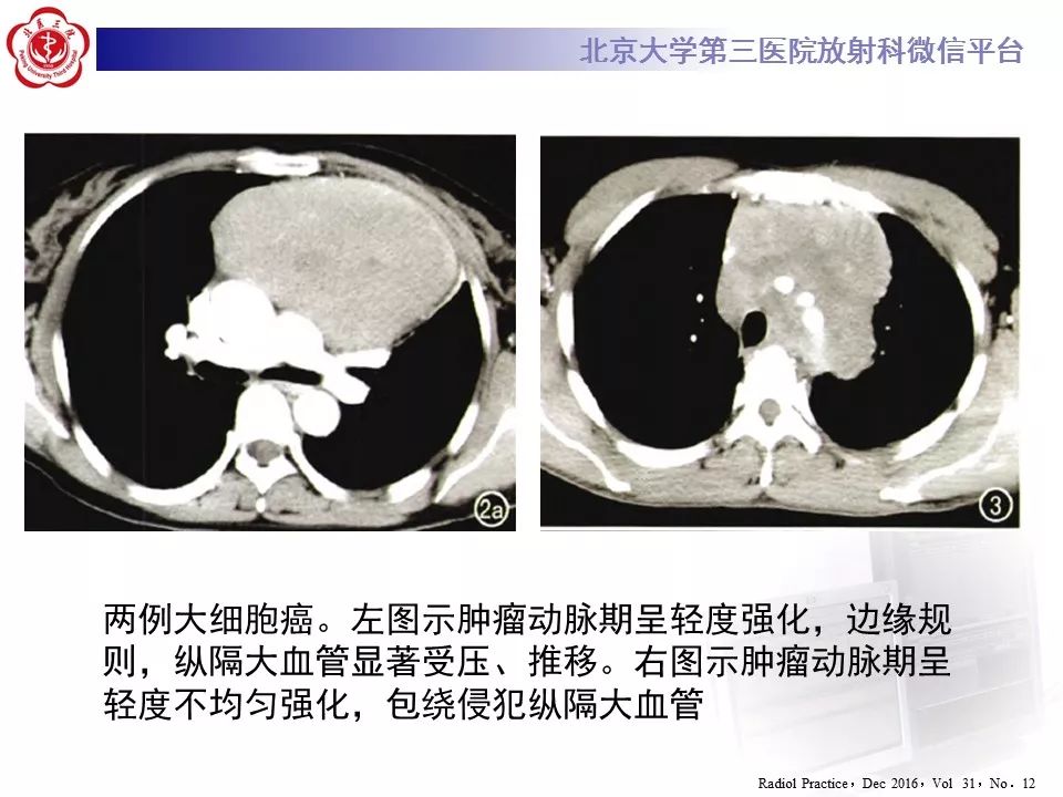 【病例】胸腺神经内分泌肿瘤1例CT影像表现