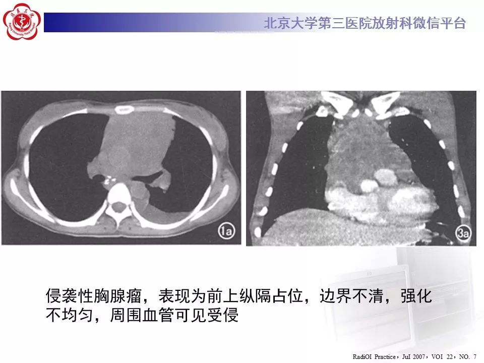 【病例】胸腺神经内分泌肿瘤1例CT影像表现