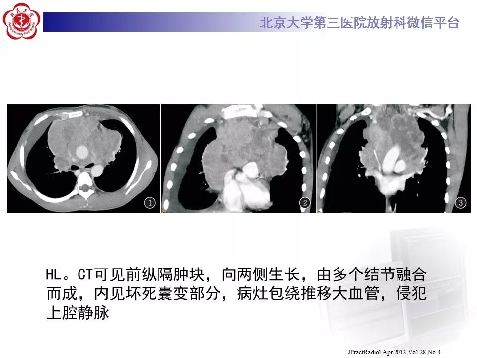【病例】胸腺神经内分泌肿瘤1例CT影像表现