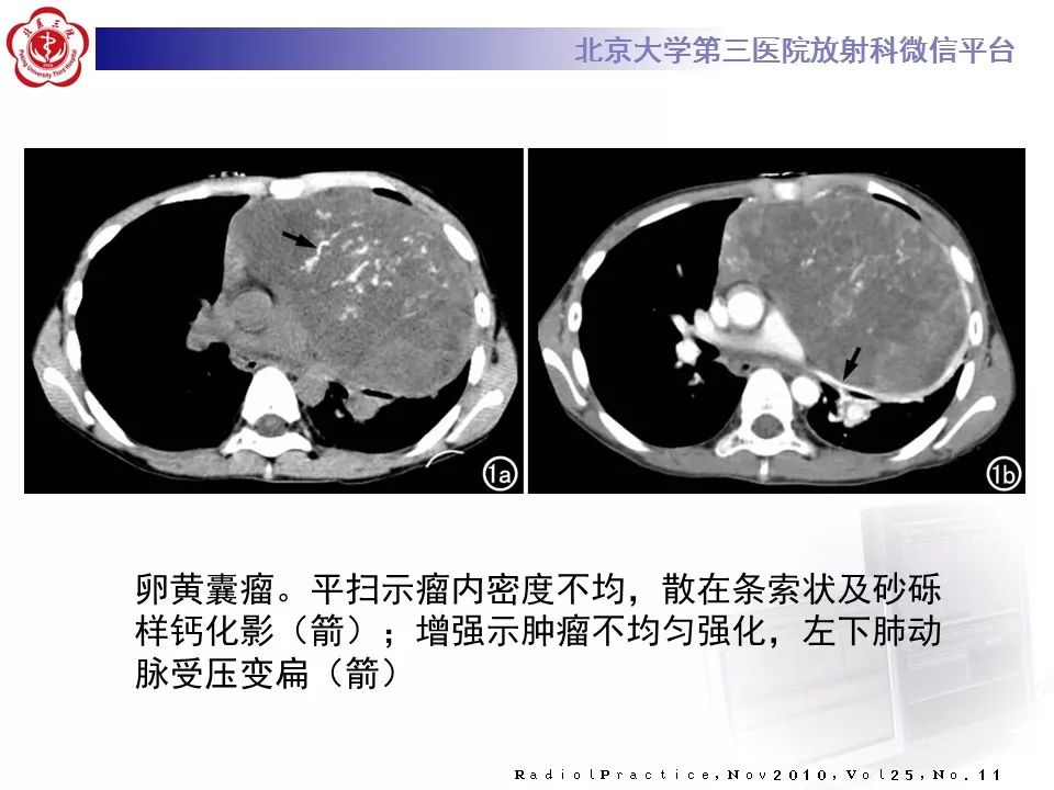 【病例】胸腺神经内分泌肿瘤1例CT影像表现