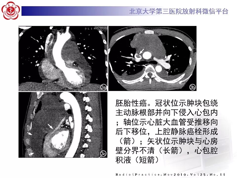 【病例】胸腺神经内分泌肿瘤1例CT影像表现