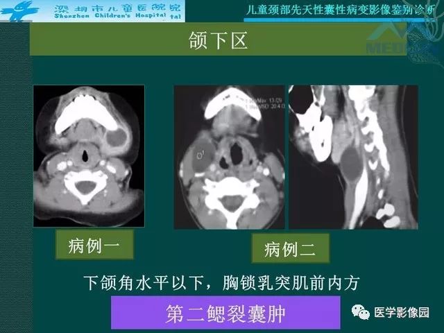 【PPT】儿童颈部先天性囊性病变影像鉴别诊断