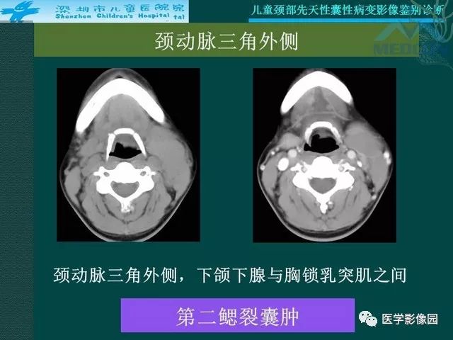 【PPT】儿童颈部先天性囊性病变影像鉴别诊断