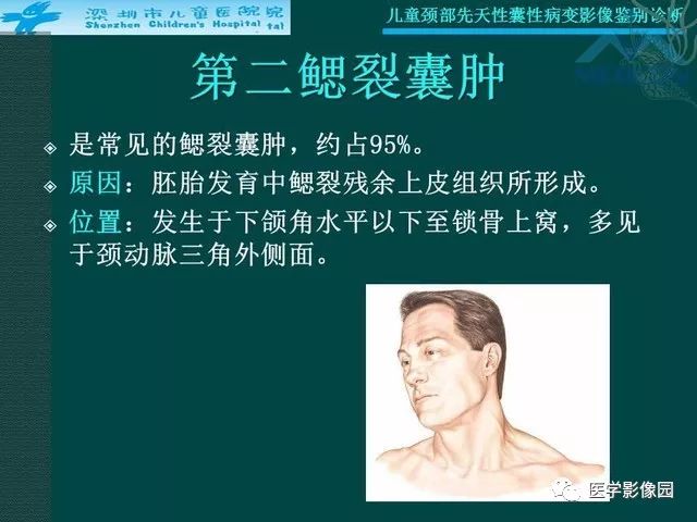 【PPT】儿童颈部先天性囊性病变影像鉴别诊断