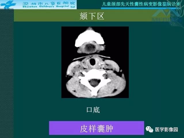 【PPT】儿童颈部先天性囊性病变影像鉴别诊断